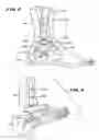 Fig. 03 - Ankle replacement system