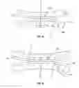 Fig. 24 - Prosthetic knee joint