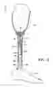 Fig. 04 - Prosthetic device utilizing electric vacuum pump