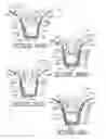 Fig. 11 - Plant package and methods of forming same using a thermoplastic flower pot