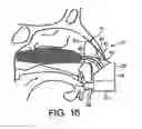Fig. 10 - Nasal devices