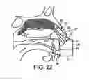 Fig. 14 - Nasal devices