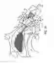 Fig. 25 - Nasal devices