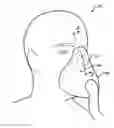 Fig. 01 - METHOD OF PARTIALLY ADHERING CPAP MASK TO FACE