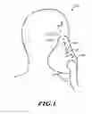 Fig. 02 - METHOD OF PARTIALLY ADHERING CPAP MASK TO FACE