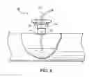 Fig. 07 - Separating sand from fluids produced by a well