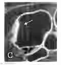 Fig. 01 - Simultaneous dual window/level settings for display of CT colonography images