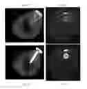 Fig. 05 - Method and apparatus for 3D metal and high-density artifact correction for cone-beam and fan-beam CT imaging