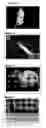 Fig. 03 - Treatment methods using a particulate cadaveric allogenic juvenile cartilage particles