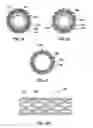 Fig. 05 - Method of making a stent with hollow struts