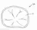 Fig. 01 - Orthodontic Appliance