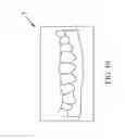 Fig. 11 - Orthodontic Appliance