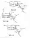 Fig. 05 - APPARATUS, SYSTEM, AND METHOD FOR REMOVAL OF DENTAL PROSTHESIS