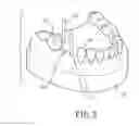 Fig. 03 - GUIDE PIN FOR DENTAL IMPLANTATION