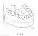 Fig. 04 - GUIDE PIN FOR DENTAL IMPLANTATION