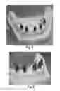 Fig. 04 - DEVICE FOR INDICATING THE POSITION AND ORIENTATION OF A DENTAL IMPLANT
