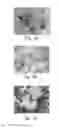 Fig. 02 - Reagents and Methods for Assessment of Human Tumor Malignancy and for Targeting Malignant Tumor Cells