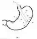 Fig. 02 - DEVICES AND METHODS FOR ANCHORING A TUBE