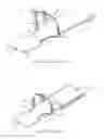 Fig. 02 - Patient positioning device primarily developed for stereotactic body radio surgery (SBRT)