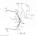 Fig. 06 - Balanced armature devices and methods for hearing