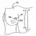 Fig. 01 - Surgical system with clips for identifying the orientation of a tissue sample