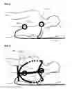 Fig. 02 - ABDOMINAL CIRCULATORY PUMP DEVICE