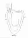 Fig. 03 - Percutaneous guidewire