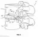 Fig. 06 - LOCKABLE IMPLANT AND METHOD OF USE