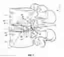 Fig. 07 - LOCKABLE IMPLANT AND METHOD OF USE