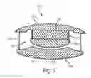 Fig. 07 - Artificial intervertebral disc implant