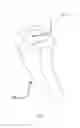 Fig. 02 - Prosthetic knee void filers with splined fixation