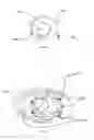 Fig. 06 - Prosthetic knee void filers with splined fixation