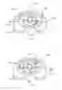 Fig. 08 - Prosthetic knee void filers with splined fixation