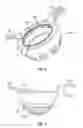 Fig. 04 - IMPLANT COMPONENTS AND METHODS