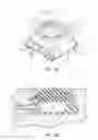 Fig. 02 - Systems and methods for radiographically identifying an access port