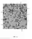 Fig. 07 - Method for detecting the presence of anisotropic crystals in undiluted whole blood