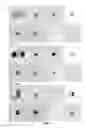 Fig. 06 - DETECTION OF CARCINOMA IN SITU IN SEMEN SPECIMENS