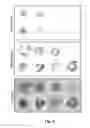 Fig. 07 - DETECTION OF CARCINOMA IN SITU IN SEMEN SPECIMENS