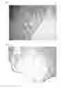 Fig. 06 - COLLAGEN IMPLANT
