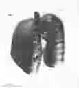Fig. 23 - Chemically-selective, label free, microendoscopic system based on coherent anti-stokes raman scattering and microelectromechanical fiber optic probe
