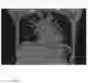 Fig. 24 - Chemically-selective, label free, microendoscopic system based on coherent anti-stokes raman scattering and microelectromechanical fiber optic probe