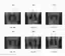 Fig. 26 - Chemically-selective, label free, microendoscopic system based on coherent anti-stokes raman scattering and microelectromechanical fiber optic probe
