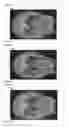 Fig. 48 - Chemically-selective, label free, microendoscopic system based on coherent anti-stokes raman scattering and microelectromechanical fiber optic probe