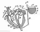 Fig. 01 - Device and Method To Discriminate Between Supraventricular Tachycardias And Ventricular Arrhythmias