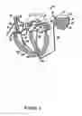 Fig. 02 - Device and Method To Discriminate Between Supraventricular Tachycardias And Ventricular Arrhythmias