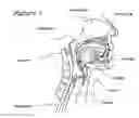 Fig. 02 - Method and device for the treatment of obstructive sleep apnea and snoring