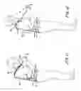 Fig. 10 - Adjustable extension compression posterior spinal orthosis and method