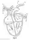 Fig. 08 - Method for increasing blood flow in or about a cardiac or other vascular or prosthetic structure to prevent thrombosis