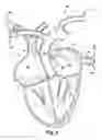 Fig. 10 - Method for increasing blood flow in or about a cardiac or other vascular or prosthetic structure to prevent thrombosis