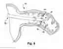 Fig. 11 - Method for increasing blood flow in or about a cardiac or other vascular or prosthetic structure to prevent thrombosis